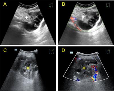 Contrast-enhanced ultrasonography findings of LAMNs with peritoneal and splenic metastases: a case report and literature review